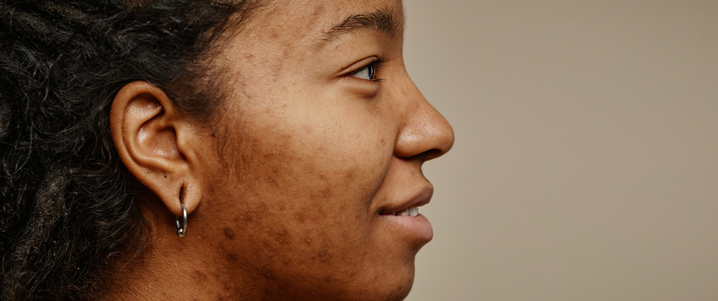 Will pimple scars on my face ever go away? - benzagel.ca